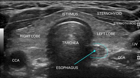 normal thyroid ultrasound pics